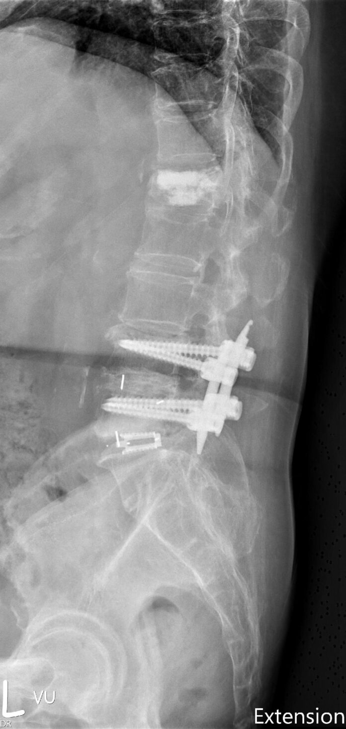 治療腰椎融合術後鄰近節病變的新選擇